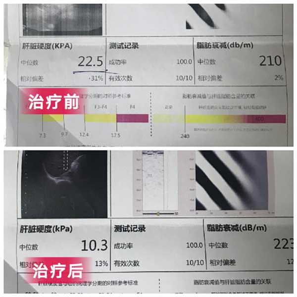 郑州看乙肝到郑州哪家肝病医院好